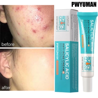 Salicylic Acid Acne Removal Cream – Anti-Acne, Oil Control & Skin Repair